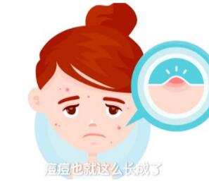 西宁治疗青春痘的医院
