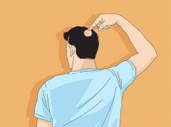 西宁哪家治疗斑秃的医院好